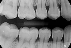 Imagem Categoria Radiografia Interproximal